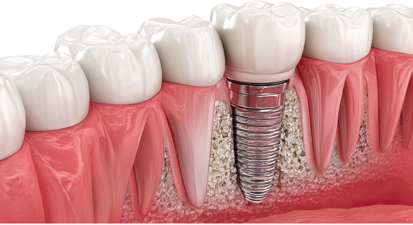 Dental Implant