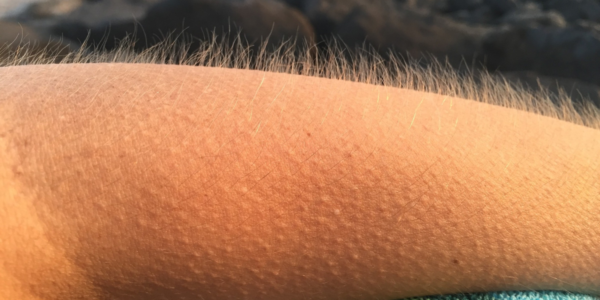 Goosebumps