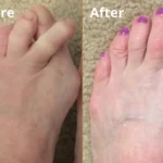 Hyggear Toe Separators