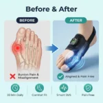 Nexalign Pro EMS Bunion Corrector