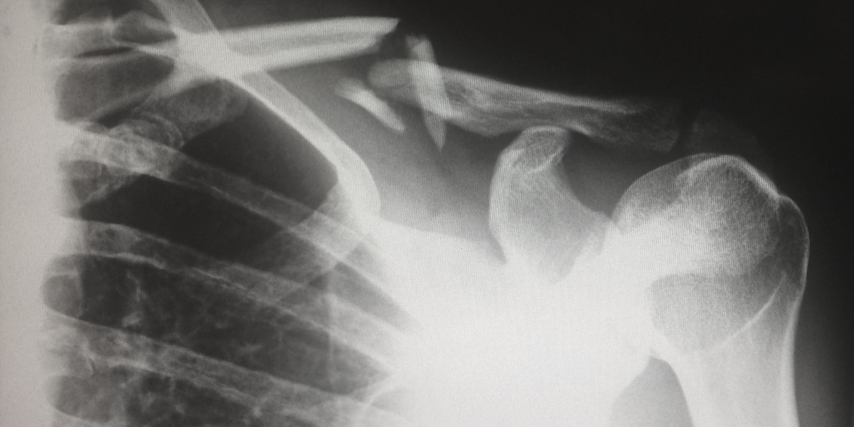 Bone.blog post feature