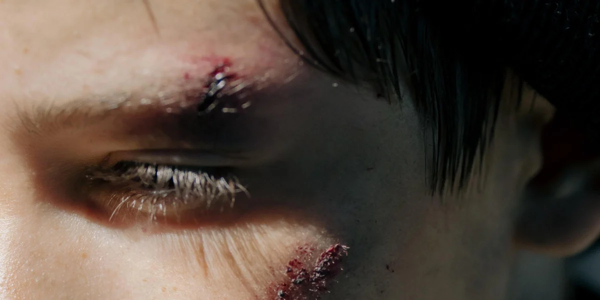 Eyebrow wound.blog post feature