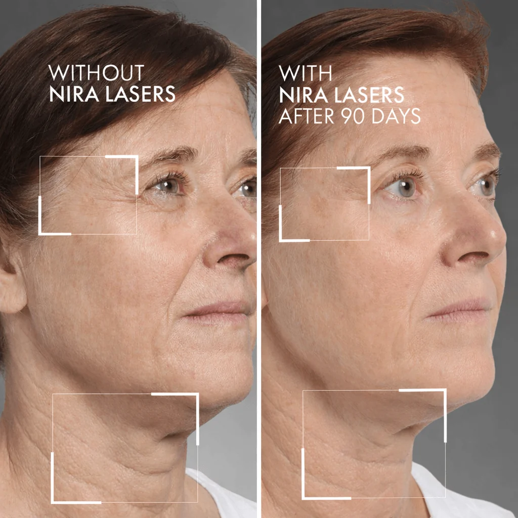 Nira before after full face pdp