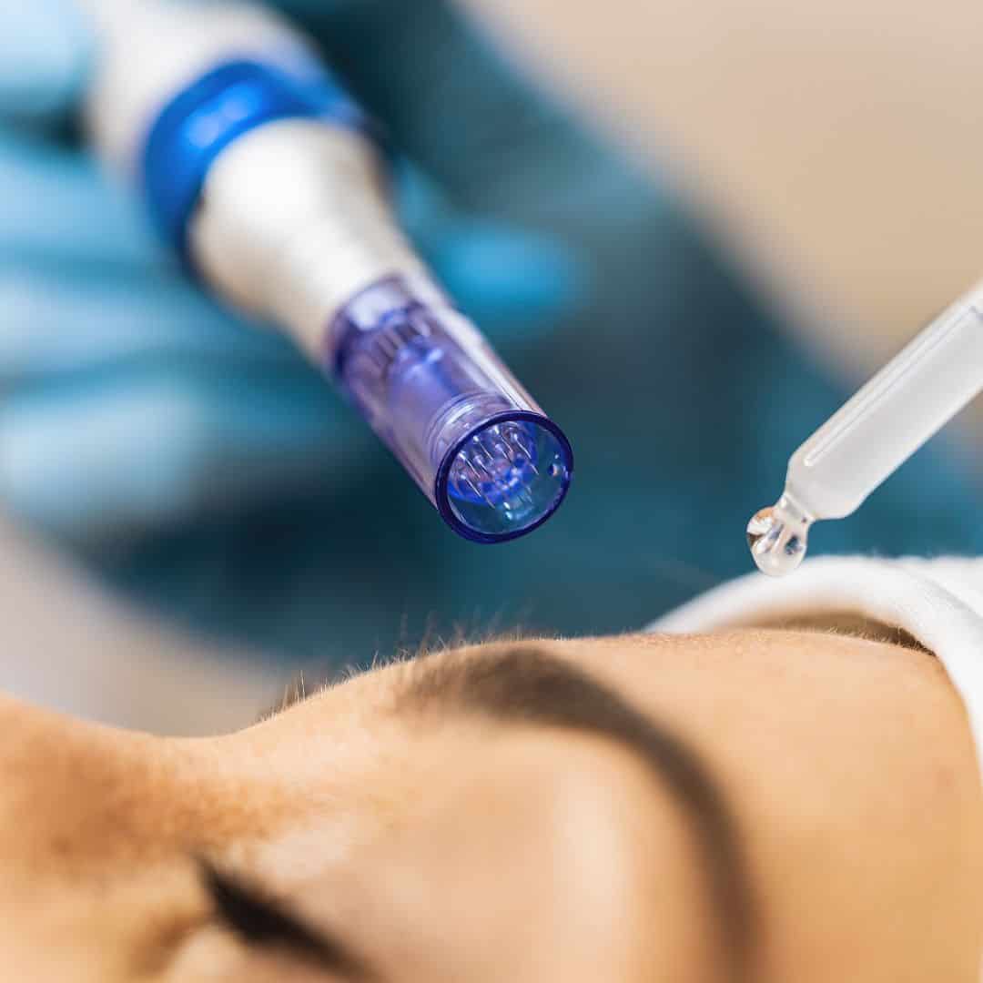 Rf microneedling