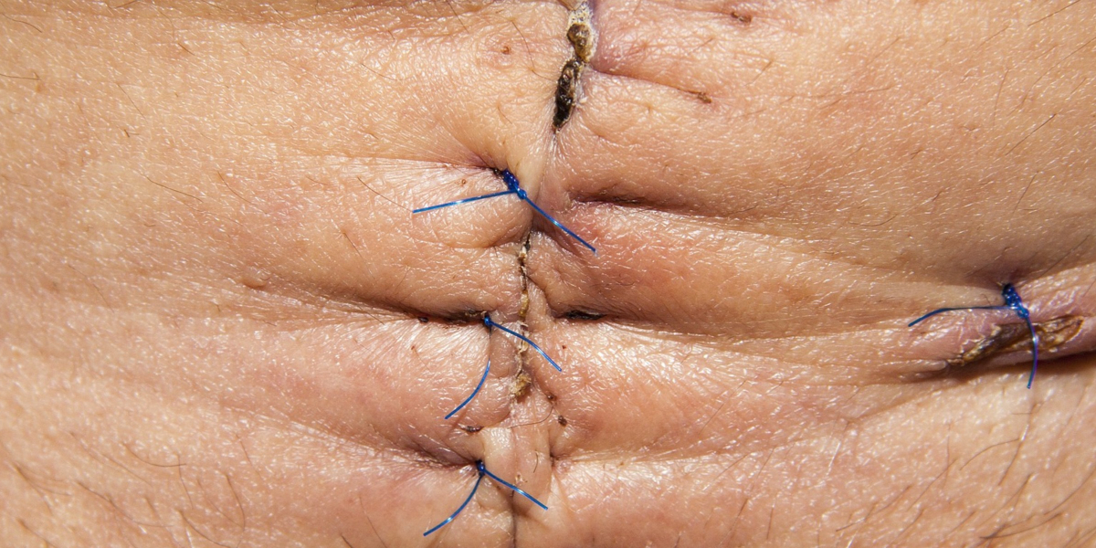 Scar skin healing
