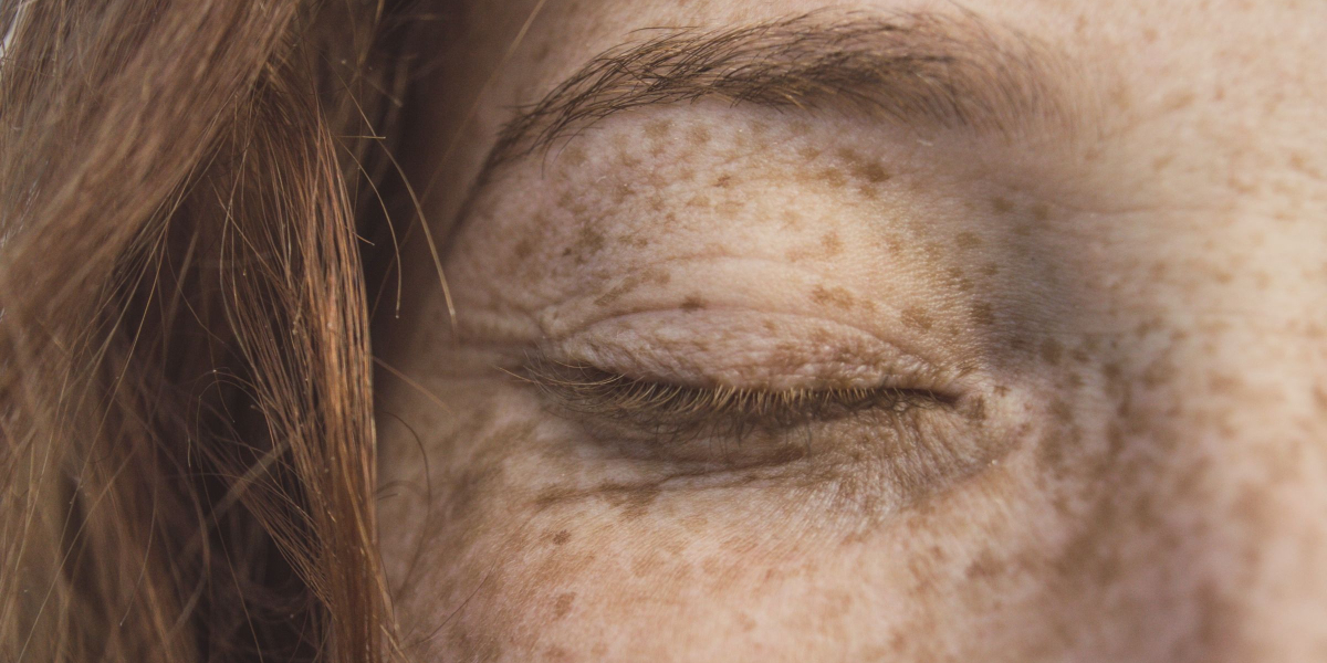 Skin cancer